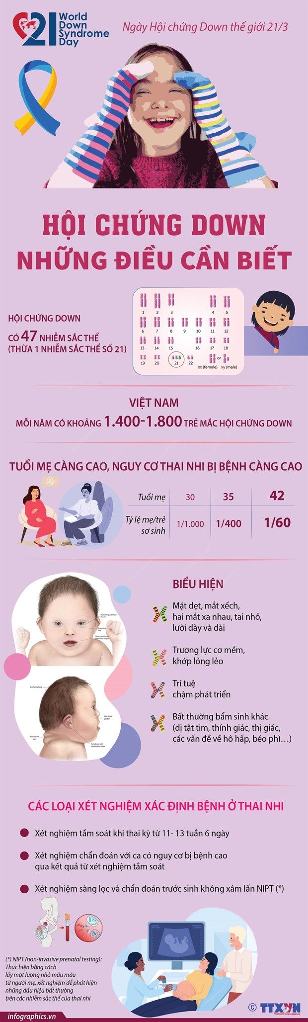 [Infographics] Những điều cần biết về hội chứng Down ở trẻ em